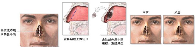 鼻中隔偏曲危害不容小觑, 耳鼻喉医院专业治疗鼻中隔偏曲